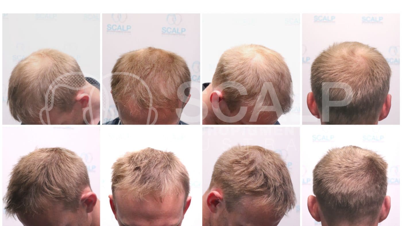 scalp micropigmentation adelaide