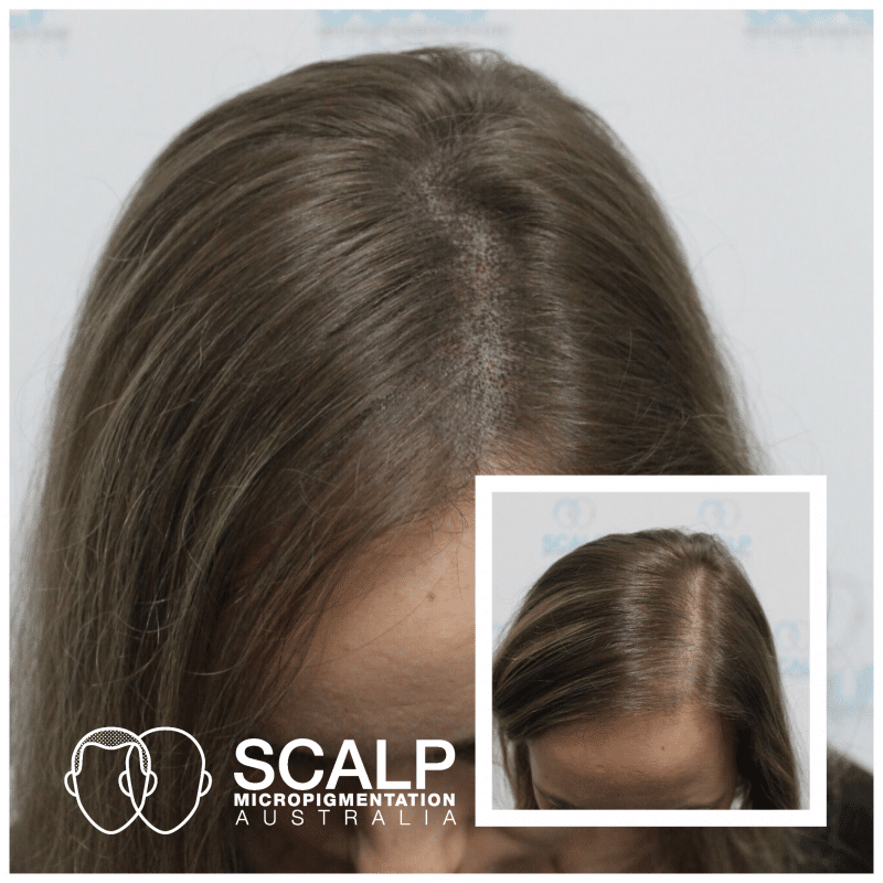 Scalp Micropigmentation For Women | SMP Australia