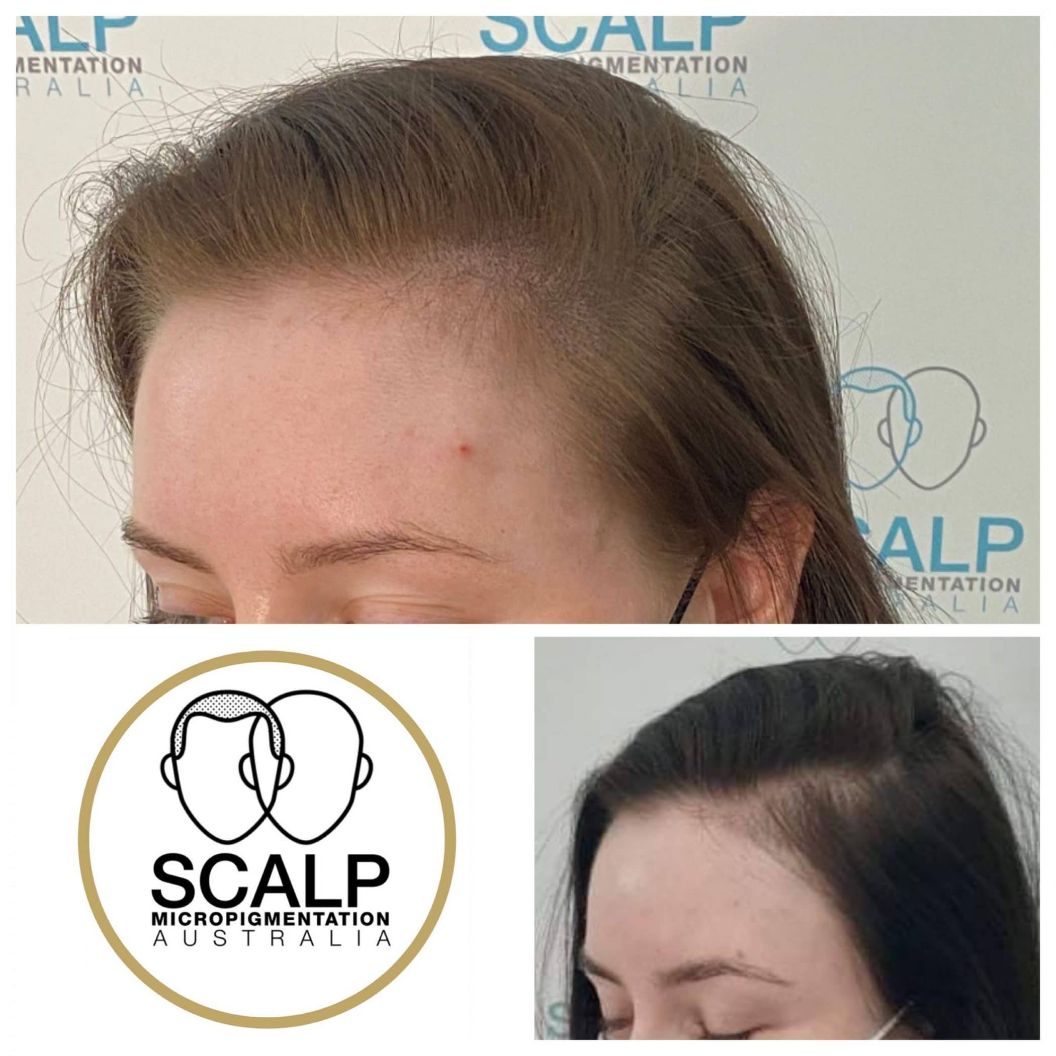 Scalp Micropigmentation For Women | SMP Australia