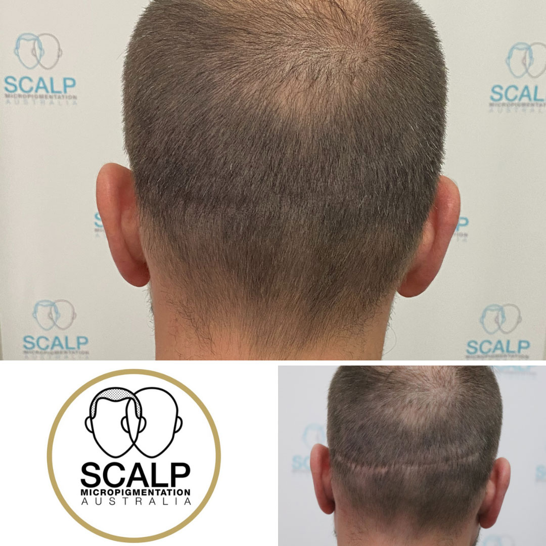 Scalp Micropigmentation For Hair Transplant Scars | SMP Australia