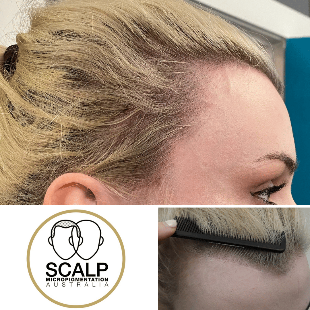 Simply Scalp | Hair Loss Solution in Surrey, London
