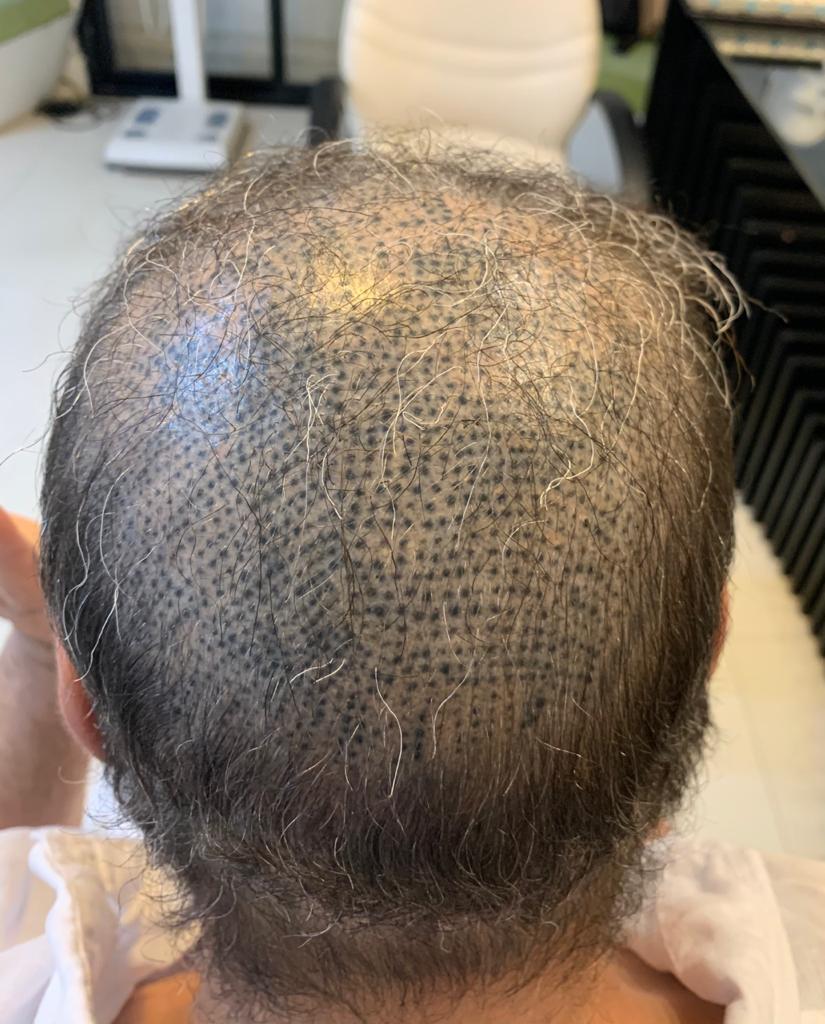 Bad-SMP-removal-scalp-micro-pigmentation-laser-blow-ou